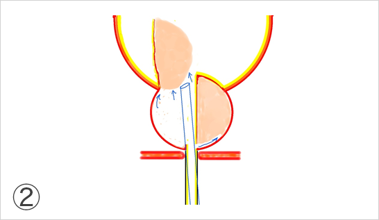 レーザーを使って外腺から内腺を膀胱に向かってはがして行きます。