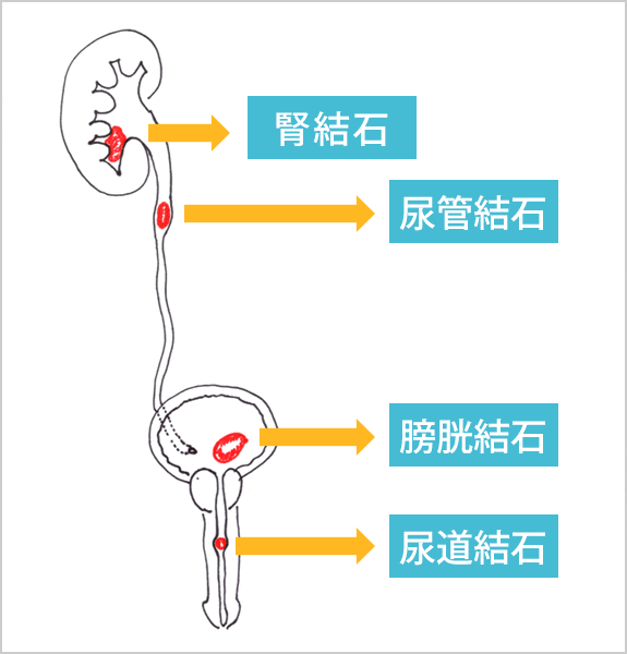 尿路結石とは?