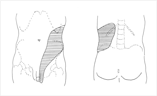 尿路結石でみられる症状