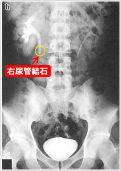 IVP (当クリニックで施行できます)